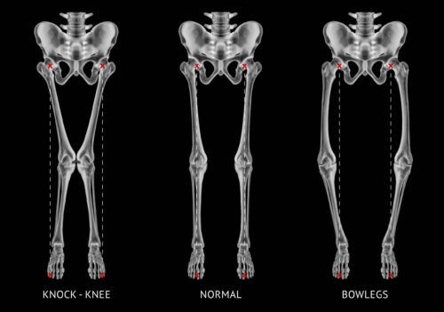 Alignment types disease leg bone problem of knock knee -Normal a